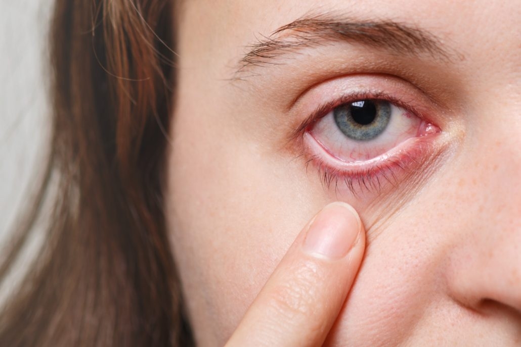 dry eye dry eye