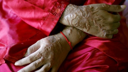 Uttar Pradesh News : लेन-देन के विवाद में सर्राफा व्यापारी ने फेंका तेजाब, तीन झुलसे, आरोपी गिरफ्तार