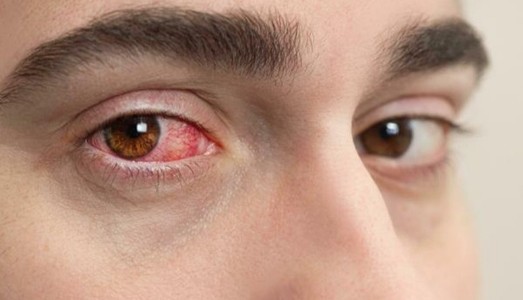 Maharajganj News : रंगों की खुमारी उतरी तो सामने आई परेशानी, नेत्र विभाग में बढ़ी भीड़